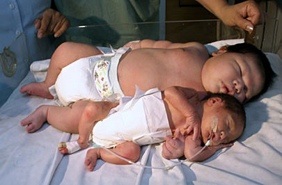 Riesenbaby in Mexiko geboren